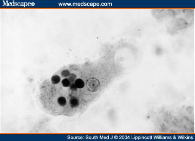 Amebic Liver Abscess