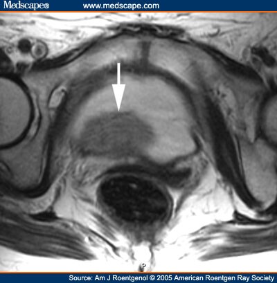 Dynamic MRI of Bladder Cancer: Evaluation of Staging Accuracy