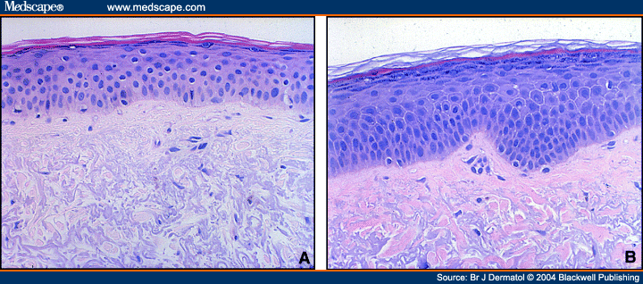 Histological Effects of Tazarotene on Photodamaged Skin