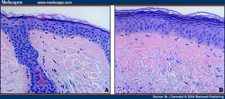 Histological Effects of Tazarotene on Photodamaged Skin