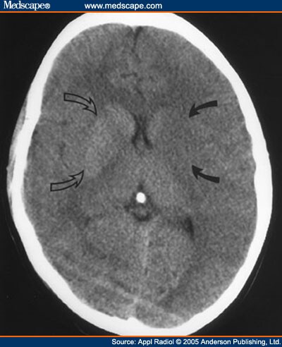 Imaging of Acute Stroke