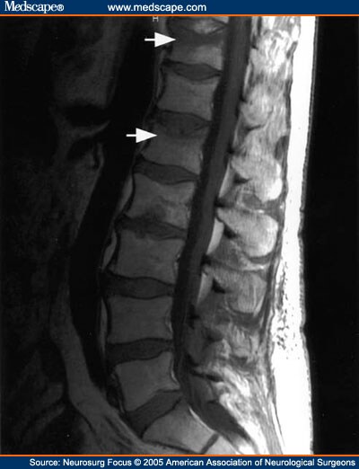 Preliminary Results of Balloon Kyphoplasty for Vertebral