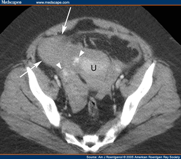 Helical CT Evaluation of Acute Right Lower Quadrant Pain, 2