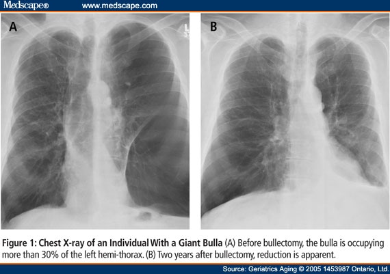 Surgical Interventions for COPD