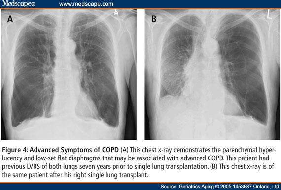 Surgical Interventions for COPD