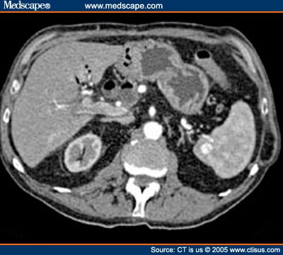 Hemangioma or AV Shunt?