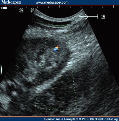 Safety and Adequacy of Renal Transplant Biopsy Protocols