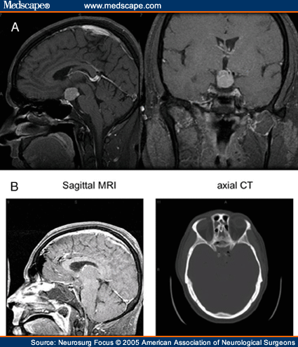 Expanded Endonasal Approach: The Rostrocaudal Axis. Part II.