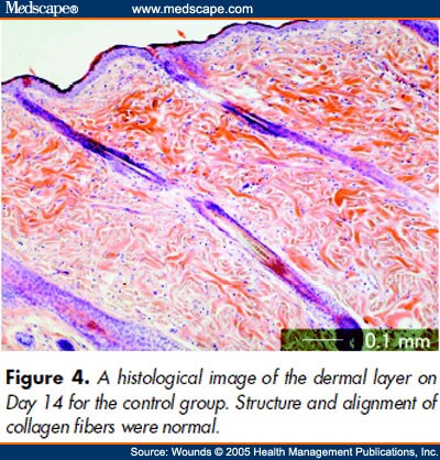 Pressure-Induced Ischemic Wound Healing