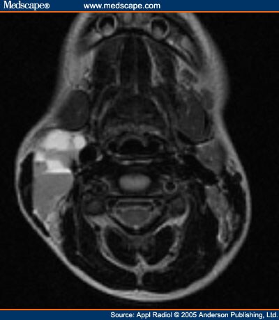 The Child With a Neck Mass