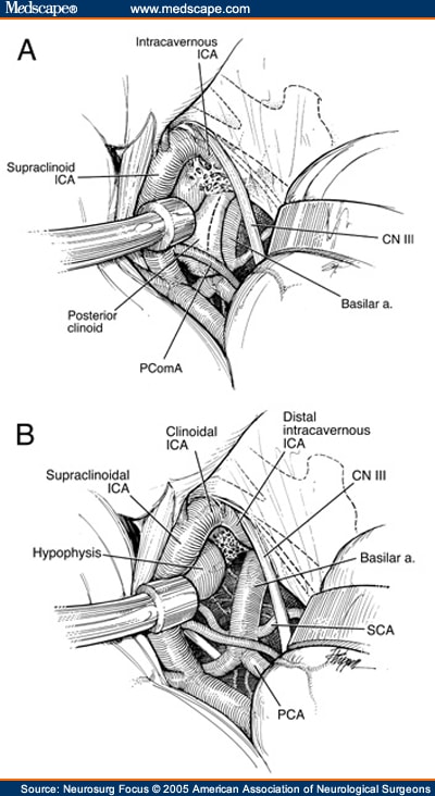 Skull Base Approaches to the Basilar Artery