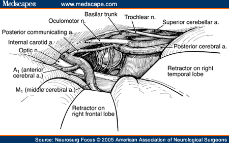 Skull Base Approaches to the Basilar Artery