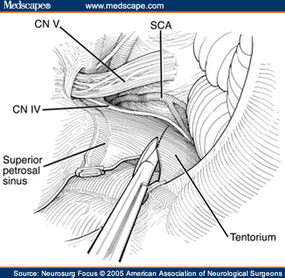 Combined Skull Base Approaches to the Posterior Fossa