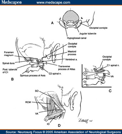 Far-Lateral Transcondylar Approach: Report of Two Cases