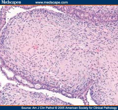 Fibroepithelial Lesions on Breast Core Needle Biopsy