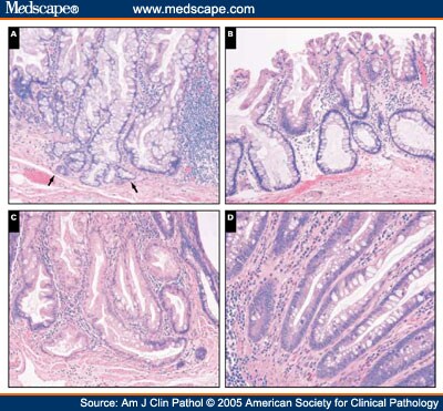 Serrated Polyps of the Large Intestine