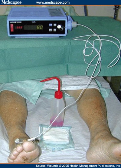 Measurements in the Diabetic Foot