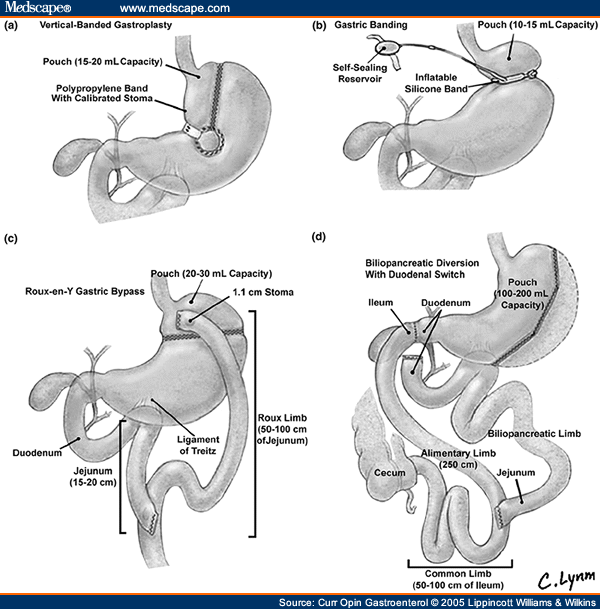 Surgery for Obesity