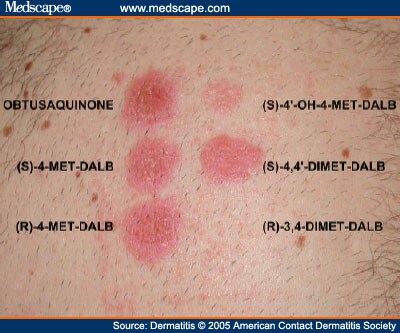 patch test results