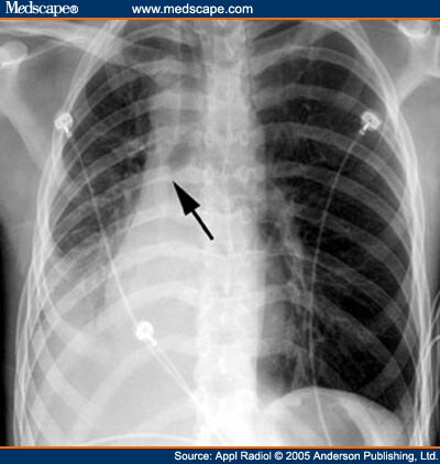 Thoracic Imaging in the Intensive Care Unit