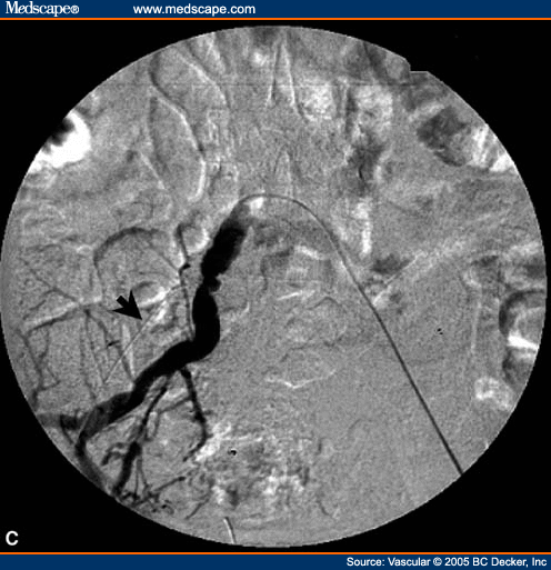 Remote Iliac Artery Endarterectomy