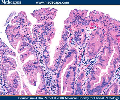 Sessile Serrated Adenoma Polypectomy Specimens: 8 Cases