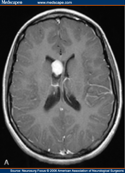 Imaging Characteristics and Growth of Giant Cell Astrocytomas