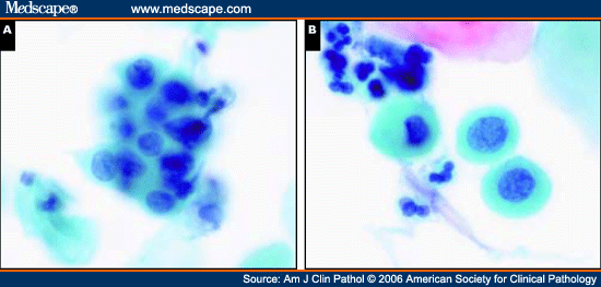 Clinical Significance of Atypical Squamous Cells, Cannot Exclude High Grade