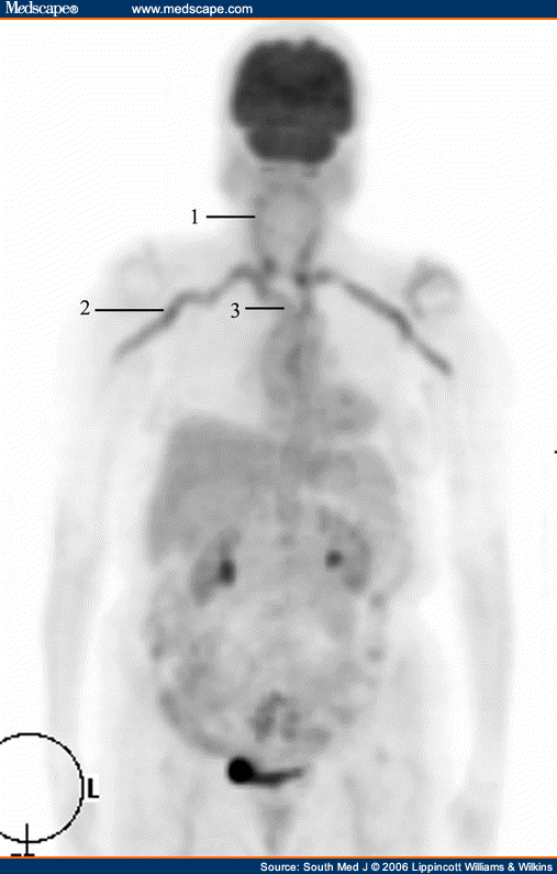 Giant Cell Arteritis Mimicking Multiple Myeloma; Diagnosed by PET Scan