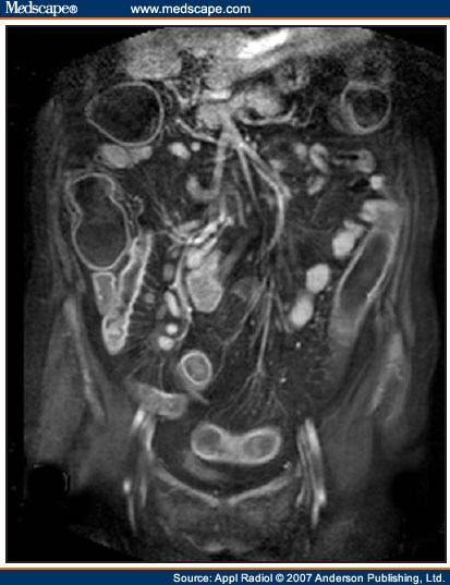 Current Status of MRI in Patients With Inflammatory Bowel Disease Colitis