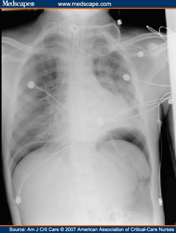 Pneumoperitoneum After Percutaneous Endoscopic Gastrostomy in ICU Patients