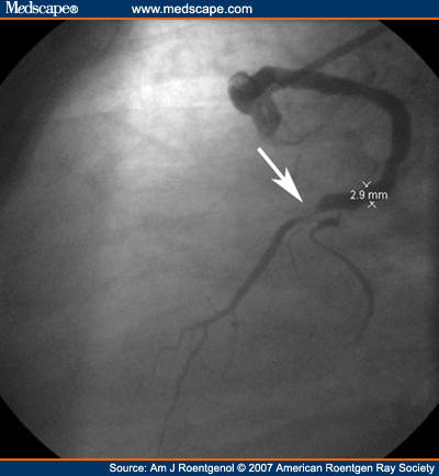 Evaluation of Aortocoronary Bypass Stents