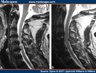 Cervical Corpectomy With Preserved Posterior Vertebral Wall for CSM