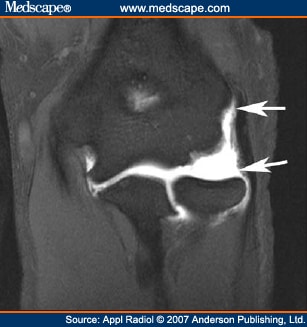 Imaging of Elbow Pathology