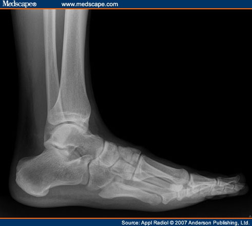 Symptomatic Bipartite Medial Cuneiform