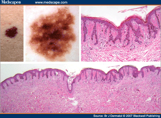 Proposal of a New Classification System for Melanocytic Naevi