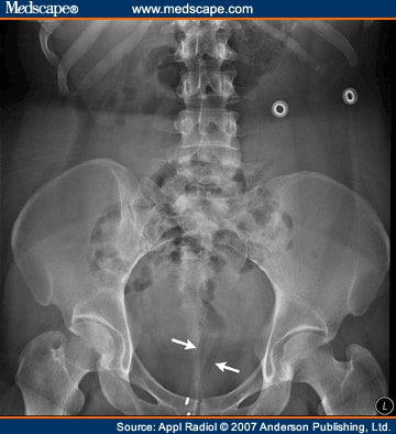 Pneumatosis Intestinalis of Sigmoid Colon Secondary to Repetitive Injury