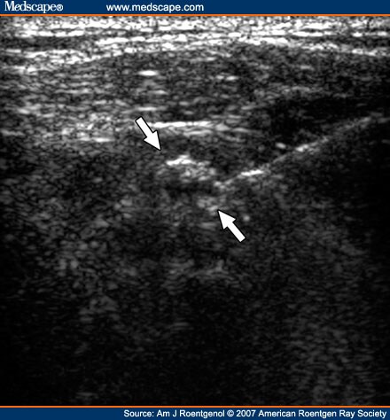 Sonographically Guided Percutaneous Needle Lavage in Calcific Tendinitis