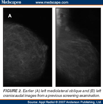 Ectopic Position of a Fractured Sternal Wire Fragment