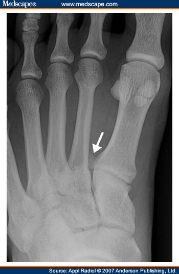 Accessory Ossicles and Sesamoid Bones: Spectrum of Pathology and Imaging