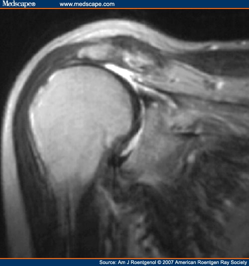 Rotator Cuff Impingement: Correlation Between Findings on MRI and Outcome