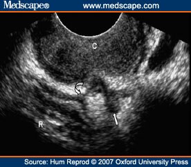 Comparisons of Clinical Examination, Transvaginal Sonography and MRI