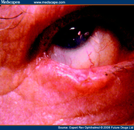 Diagnosis and Management of Malignant Tumors of the Eye