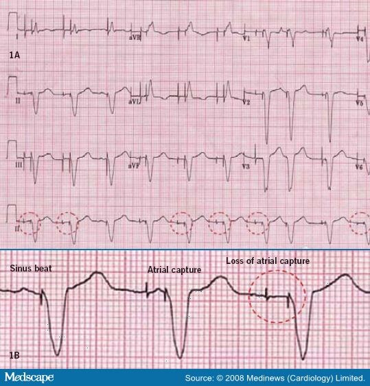 Pacemaker Syndrome - a Forgotten Diagnosis?