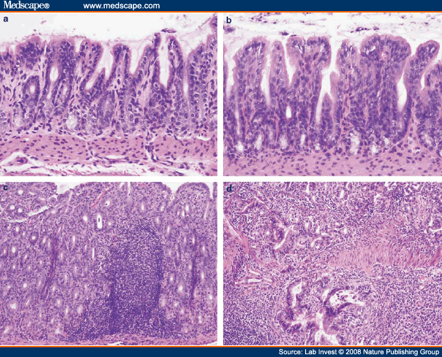 Effect of Helicobacter pylori Eradication on Gastric Carcinogenesis