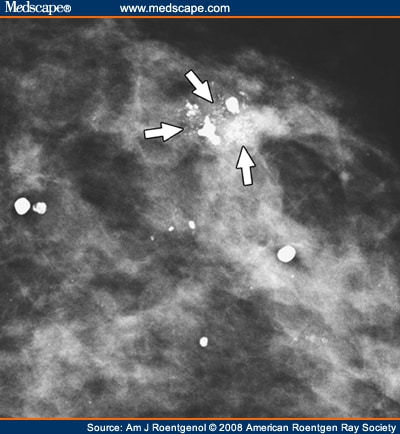 Incidence and Management of Complex Fibroadenomas