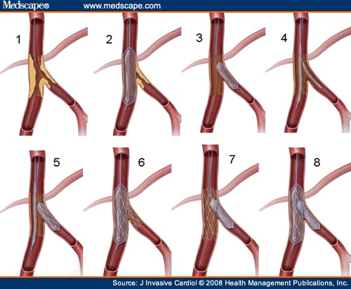 Bifurcation CAD: Current Techniques and Future Directions