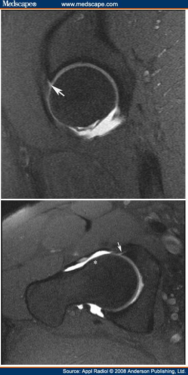 MR Imaging of Femoroacetabular Impingement