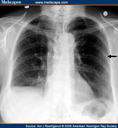 Small Lung Cancer Detection with Dual-Energy Subtraction Chest Radiography