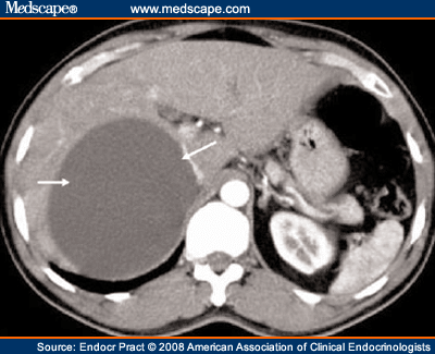 Adrenal Incidentalomas